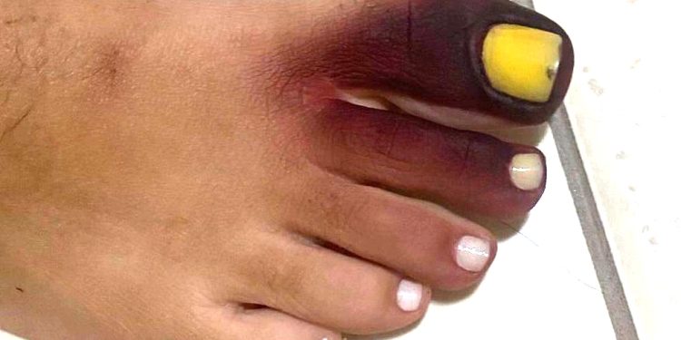 Carioca fica com pé roxo e unha amarela ao calçar tênis com piolho-de-cobra