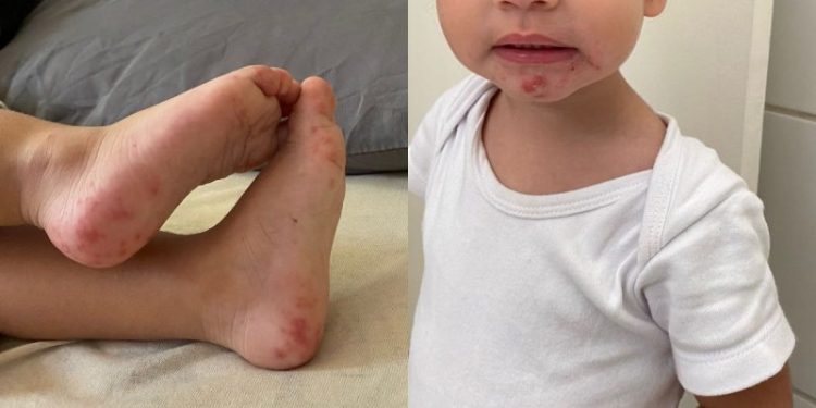 ‘Começou com febre’: 167 crianças de Florianópolis tiveram ‘mão-pé-boca’ em 2023; veja o surto